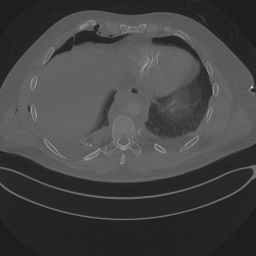 Chest multitrauma - aortic injury (Radiopaedia 34708-36147 Axial bone window 226).png