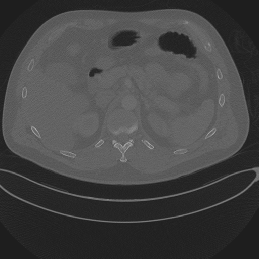 Chest multitrauma - aortic injury (Radiopaedia 34708-36147 Axial bone window 307).png