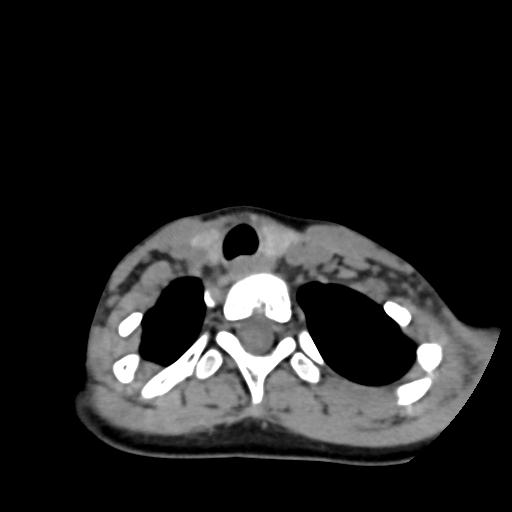 Chiari I with syrinx and skull base anomalies (Radiopaedia 89444-106412 Axial non-contrast 125).jpg