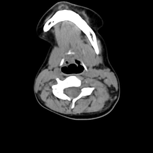 Chiari I with syrinx and skull base anomalies (Radiopaedia 89444-106412 Axial non-contrast 85).jpg