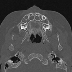 Choanal atresia (Radiopaedia 88525-105975 Axial bone window 12).jpg
