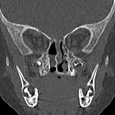 Choanal atresia (Radiopaedia 88525-105975 Coronal bone window 63).jpg