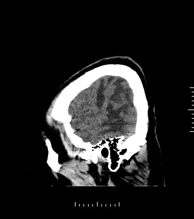 Cholangiocarcinoma with cerebral metastases (Radiopaedia 83519-98628 C 5).jpg
