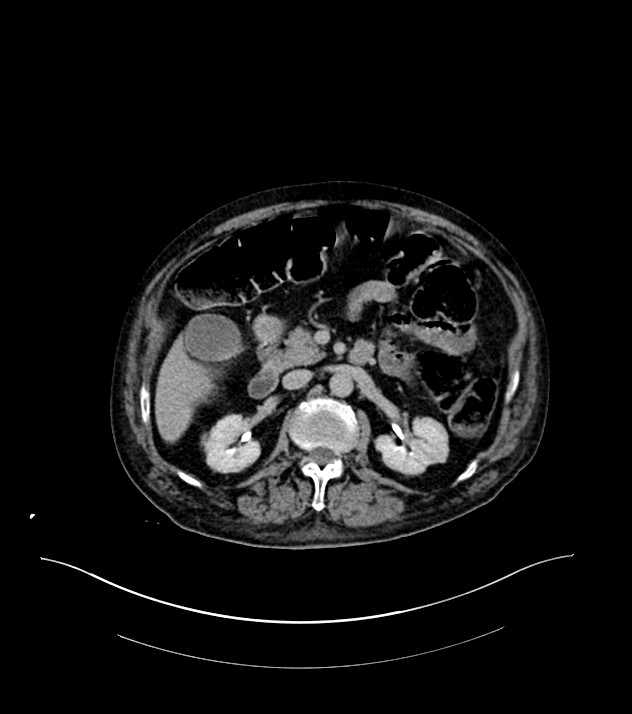 Cholangiocarcinoma with cerebral metastases (Radiopaedia 83519-98629 Axial C+ delayed 44).jpg