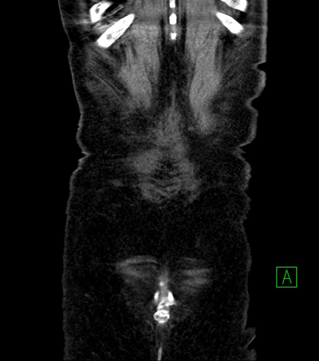 Cholangiocarcinoma with cerebral metastases (Radiopaedia 83519-98629 E 84).jpg