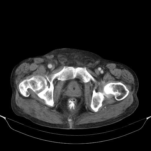 File:Cholangitis and abscess formation in a patient with cholangiocarcinoma (Radiopaedia 21194-21100 A 49).jpg
