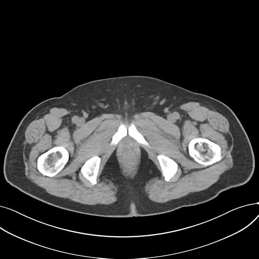 File:Cholecystitis with focal perforation and hepatic abscess (Radiopaedia 37189-38945 Axial non-contrast 89).png