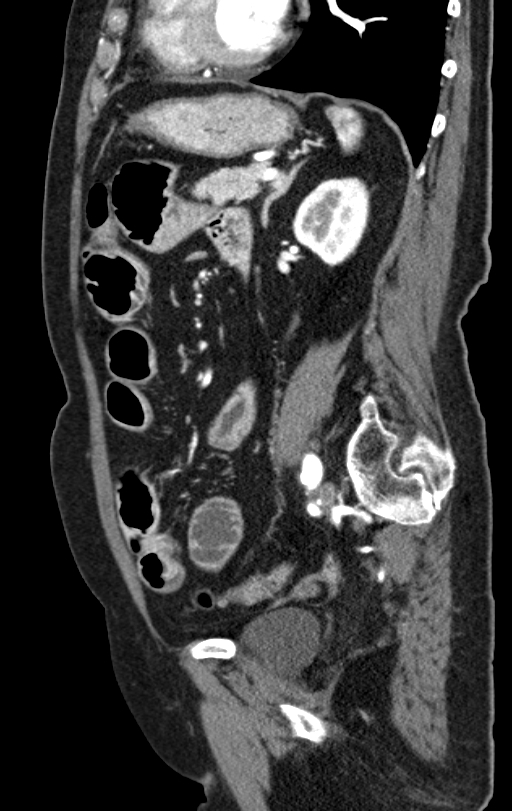 Cholecystoduodenal fistula due to calculous cholecystitis with gallstone migration (Radiopaedia 86875-103077 C 23).jpg