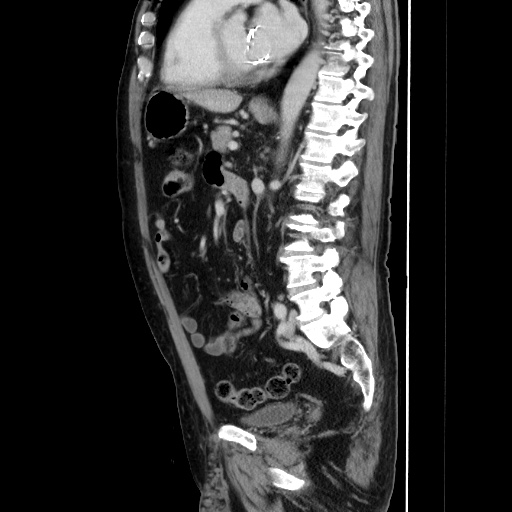 Choledocholiathiasis with normal caliber common bile duct (Radiopaedia 75368-86632 D 95).jpg