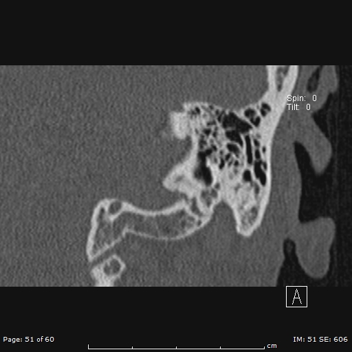 Cholesteatoma - external auditory canal (Radiopaedia 88452-105096 Coronal bone window 51).jpg
