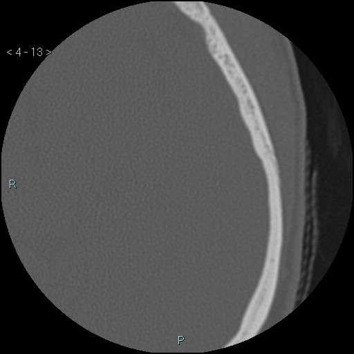 File:Cholesterol granuloma of the petrous apex (Radiopaedia 64358-73141 Axial bone window 7).jpg