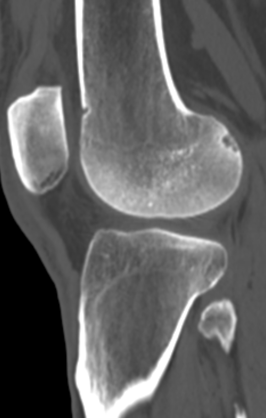 Chondrocalcinosis (Radiopaedia 82862-97173 Sagittal bone window 42).jpg
