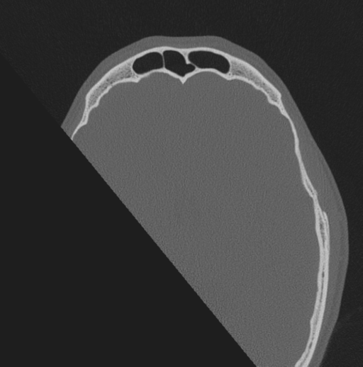 Chondrosarcoma (clivus) (Radiopaedia 46895-51425 Axial bone window 2).png