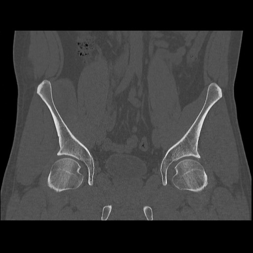 Chondrosarcoma of iliac wing (Radiopaedia 63861-72599 Coronal bone window 52).jpg