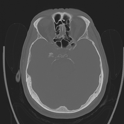 Chondrosarcoma of skull base- grade II (Radiopaedia 40948-43653 Axial bone window 16).png