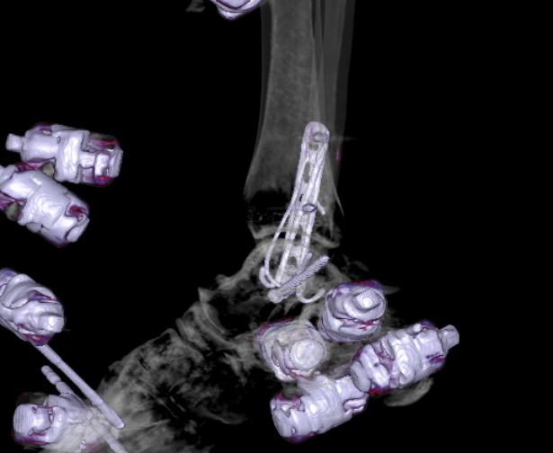File:Chopart fracture (Radiopaedia 35347-36861 3D MPR bone window 12).jpg