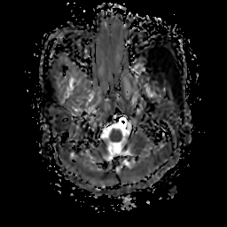 File:Chordoid glioma of third ventricle (Radiopaedia 91612-109340 Axial ADC 4).jpg