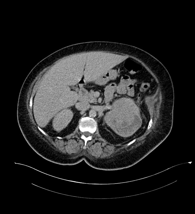 Chromophobe renal cell carcinoma (Radiopaedia 84239-99519 E 66).jpg