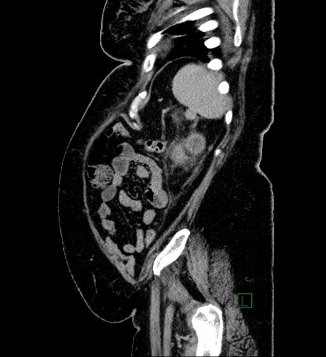 Chromophobe renal cell carcinoma (Radiopaedia 84239-99519 G 23).jpg