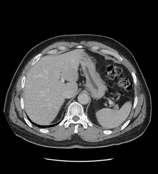 Chromophobe renal cell carcinoma (Radiopaedia 86879-103083 C 27).jpg