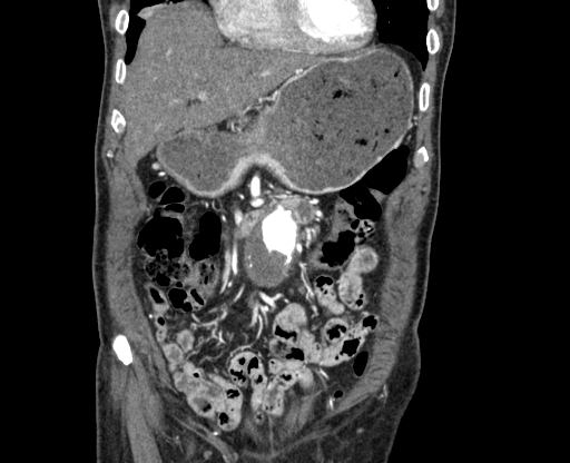 Chronic contained rupture of abdominal aortic aneurysm with extensive erosion of the vertebral bodies (Radiopaedia 55450-61901 D 10).jpg