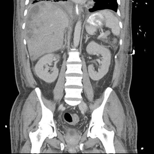 Chronic diverticulitis complicated by hepatic abscess and portal vein thrombosis (Radiopaedia 30301-30938 B 37).jpg