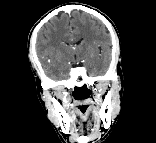 Chronic invasive fungal sinusitis with intraorbital and intracranial extension (Radiopaedia 56387-63046 C 191).jpg