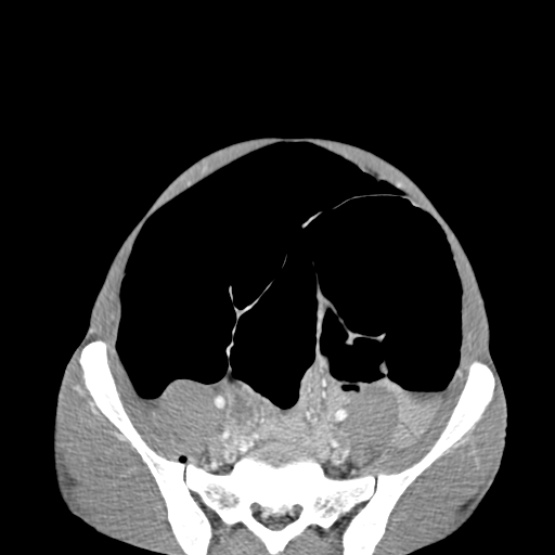 Chronic large bowel pseudo-obstruction (Radiopaedia 43181-46492 A 129).jpg