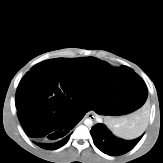 Chronic large bowel pseudo-obstruction (Radiopaedia 43181-46492 A 37).jpg
