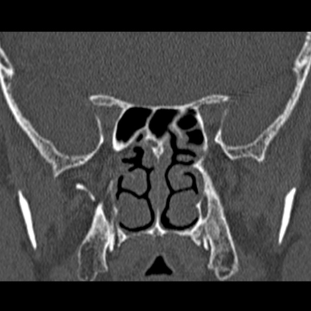 Chronic maxillary sinusitis (Radiopaedia 27879-28116 Coronal bone window 38).jpg
