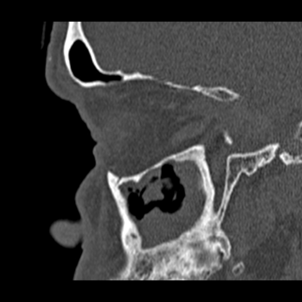 Chronic maxillary sinusitis (Radiopaedia 27879-28116 Sagittal bone window 14).jpg