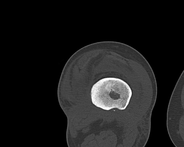Chronic ostemyelitis of the femur with long sinus tract (Radiopaedia 74947-85982 Axial bone window 171).jpg