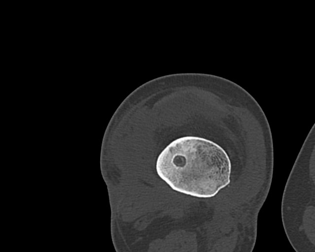 File:Chronic ostemyelitis of the femur with long sinus tract (Radiopaedia 74947-85982 Axial bone window 186).jpg