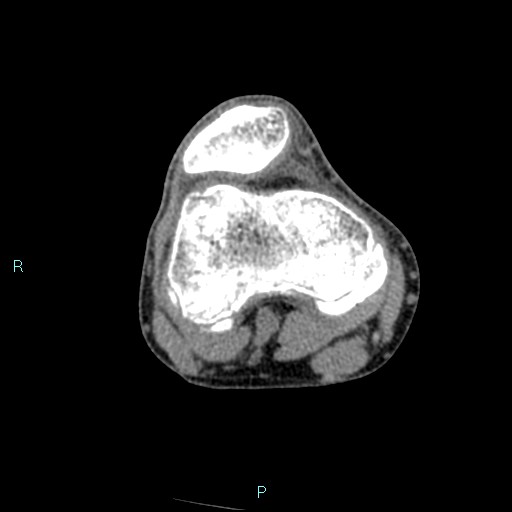 Chronic osteomyelitis (with Brodie abscess) (Radiopaedia 76405-88111 A 144).jpg