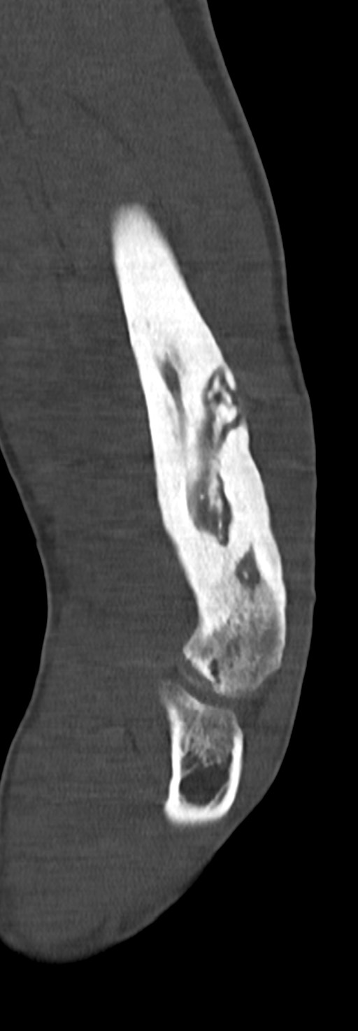 Chronic osteomyelitis of the distal humerus (Radiopaedia 78351-90971 Sagittal bone window 50).jpg