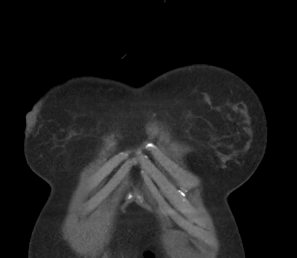 Chronic pulmonary embolus (Radiopaedia 39129-41341 Coronal C+ CTPA 10).png