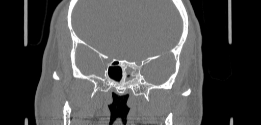 File:Chronic sphenoidal sinusitis (Radiopaedia 62030-70122 Coronal bone window 112).jpg
