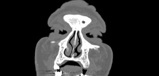 Chronic sphenoidal sinusitis (Radiopaedia 62030-70122 Coronal bone window 13).jpg