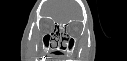 Chronic sphenoidal sinusitis (Radiopaedia 62030-70122 Coronal bone window 61).jpg
