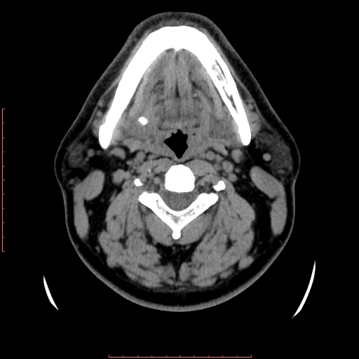 Chronic submandibular sialolithiasis (Radiopaedia 69817-79814 Axial non-contrast 105).jpg