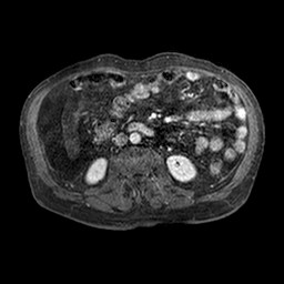 Cirrhosis and hepatocellular carcinoma in the setting of hemochromatosis (Radiopaedia 75394-86594 Axial T1 C+ fat sat 181).jpg