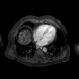 Cirrhosis and hepatocellular carcinoma in the setting of hemochromatosis (Radiopaedia 75394-86594 Axial T1 C+ fat sat 251).jpg