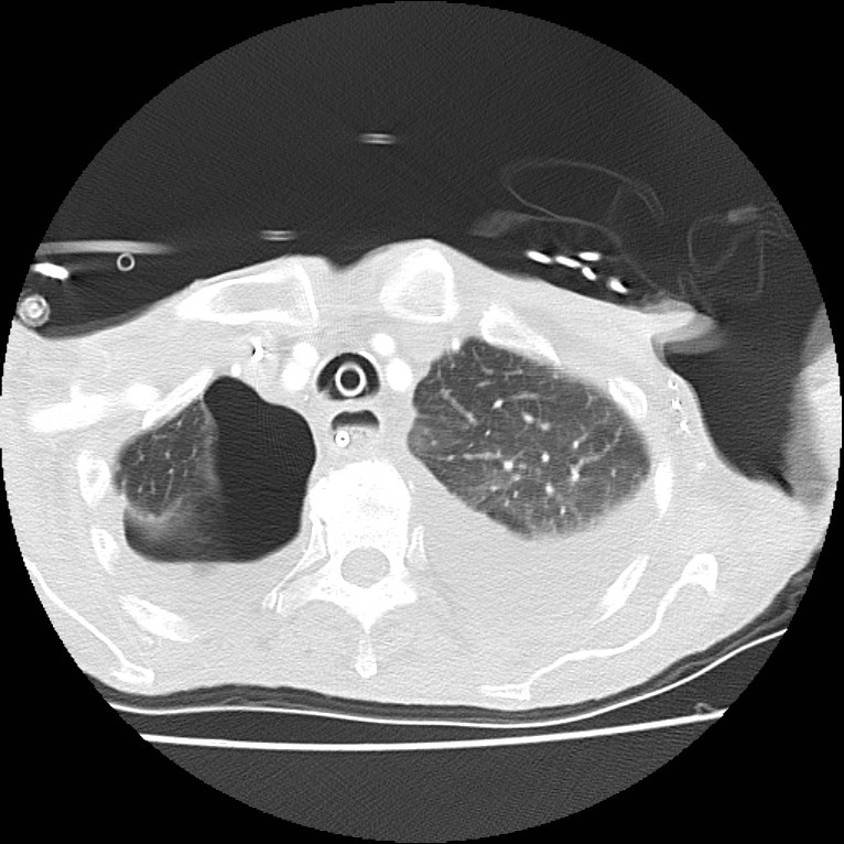Clagett thoracotomy with bronchopleural fistula (Radiopaedia 29192-29587 Axial lung window 8).jpg
