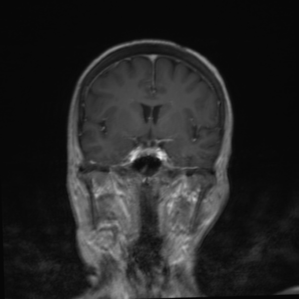 File:Clival meningioma (Radiopaedia 53278-59248 F 13).jpg