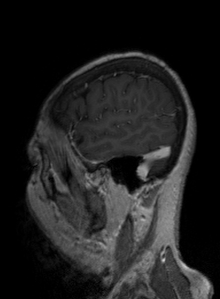 Clival meningioma (Radiopaedia 53278-59248 Sagittal T1 C+ 159).jpg