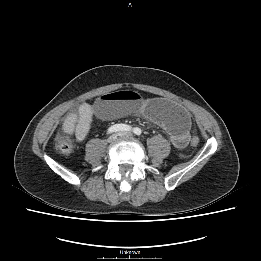 Closed loop bowel obstruction and ischemia (Radiopaedia 86959-103180 A 52).jpg