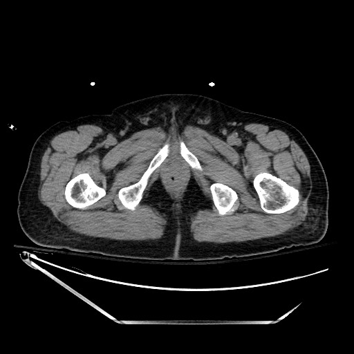 File:Closed loop obstruction due to adhesive band, resulting in small bowel ischemia and resection (Radiopaedia 83835-99023 Axial non-contrast 164).jpg