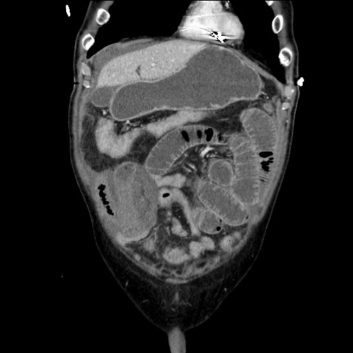 Closed loop obstruction due to adhesive band, resulting in small bowel ischemia and resection (Radiopaedia 83835-99023 E 35).jpg