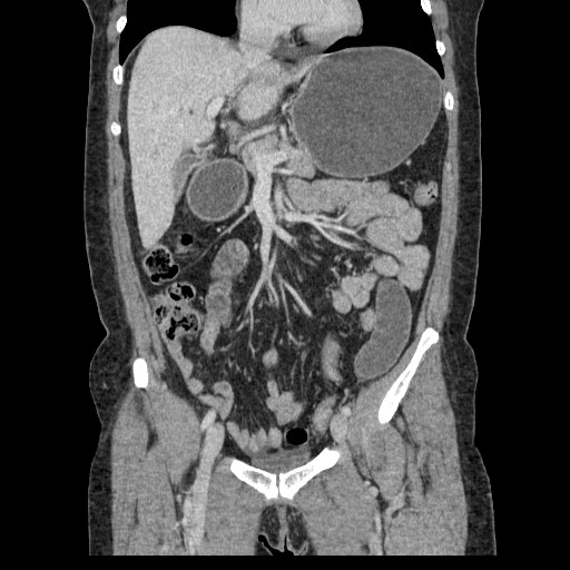 Closed loop small bowel obstruction (Radiopaedia 65403-74451 B 48).jpg