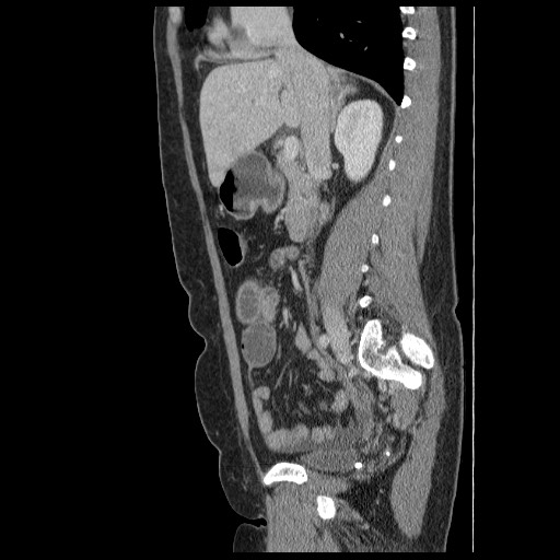 File:Closed loop small bowel obstruction (Radiopaedia 65403-74451 C 40).jpg